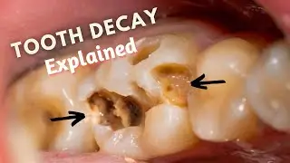 What Causes TOOTH DECAY? | Know How CAVITIES Develop!