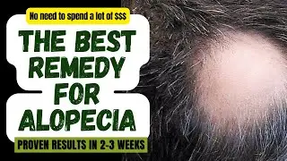 The BEST REMEDY For ALOPECIA [Alopecia Areata]