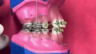 Power Arm para mesializar molares com ancoragem esquelética.