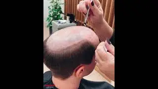 Hair replacement- Aderans Sweden