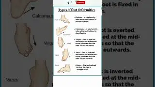 #foot #deformity #types #anatomy #shorts #shortvideo #medical @dr.aneeqaphysiotherapist571