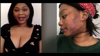 Hyperpigmentation & Acne Update | 2 months on Obagi Nu-Derm System