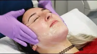 Image Perfection Peel with Elizabeth | The Laser and Skin Clinic
