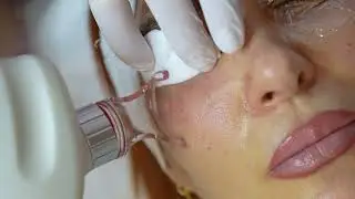 elvimed innovative dermatology center / CO2 laser post acne, scar treatment