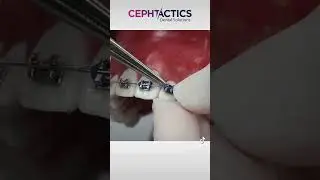How to place modules or elastic ligatures on fixed braces?