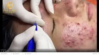 Relax every day with Acne treatment with TM Queen yt #20028