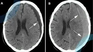 شرح المحاضره الرابعه دوره الاشعه المقطعيه علي المخ CT Brain 🧠