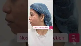 Nose Filler Injection #doctor #aesthetic #medicine #nosefiller #beautiful #nonsurgical #noninvasive
