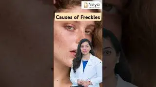 Causes of Freckles on Face | Sun exposure skin problems #frecklesface #freckles