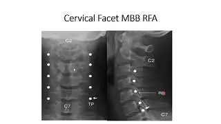 Cervical Facet joint ( median branch) Radiofrequency ablation - A stepwise approach
