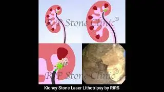 Kidney Stone Laser Lithotripsy by RIRS