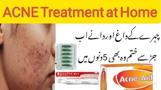 Acne treatment at Home|acne ka gharelo elaj #acne_removal