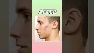 How to remove Pimples On Your face Editing || Appne face se Pimple kaise Hataye || Lightroom Edit ||