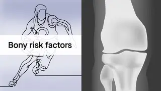 Are anatomical thresholds for predicting ACL injury risk too high?