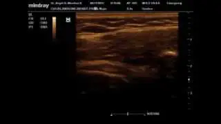 Tendon Subescapular en maniobra dinamica