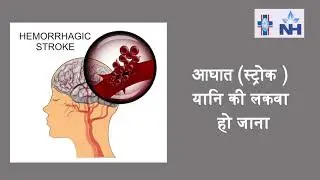 Atrial Fibrillation | Dr. Sajal Gupta (Hindi)
