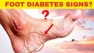10 WARNING SIGNS  Your Feet Are SCREAMING You Have Diabetes!