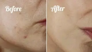 💖 The Best Way to Cover a Rosacea/Acne Breakout with Sensitive Skin Makeup