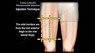 .Vastus Lateralis Intramuscular Injection: Safe and Effective Technique