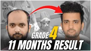 Best Hair Transplant Result 2022 | Grade 4 | Case Study | QHT Clinic Haridwar