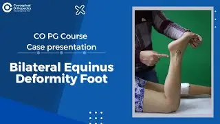 Bilateral Equinus Deformity Foot @ConceptualOrthopedics