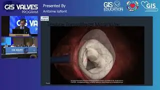 26  Antoine lafont   TMVI Using Novel Percutaneous Valves Tendyne