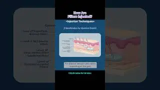 Техника корейской косметологии с использованием филлеров | Методы инъекций и выбор иглы 🌿