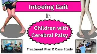 Intoeing Gait in Children with Cerebral Palsy: Causes, Treatment & Case Report - Trishla Foundation
