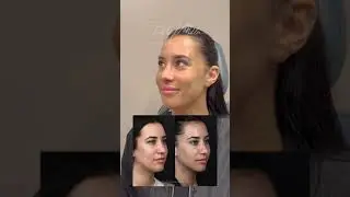 Gorgeous Liplift and Rhinoplasty Results! Happy NYC Patient Shares Her Experience!