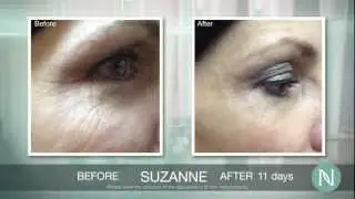 NeriumAD before & after picture reel