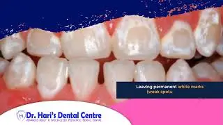 What happens when you don't brush your teeth properly that has braces? | Dr. Hari's Dental Centre