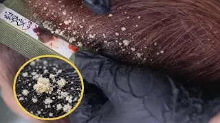 Deep Scalp Cleaning ASMR | Extreme Dandruff Removal & Relaxing Hair Care