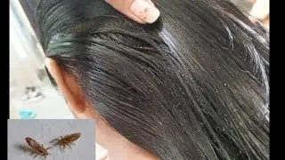 &ldquo;Jue Se Chhutkara Pao Ek Din Mein | Lice Treatment at Home&rdquo;#liceremoval #hair #saima #haircare 