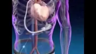 Artificial Heart: A Lifesaving Innovation | Narayana Health
