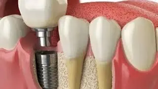 Имплантация зубных протезов. Заключительный этап. Честный отзыв. 