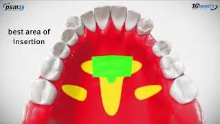 PSM ORGINAL BENEfit TAD Beneslider mesial/distal_09-2019