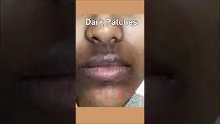 Skin Brightening cream | Melaglow Cream |Pigmentation | Dark spots | #brightening #beauty #melasma