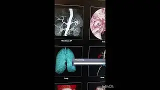 Abdominal Aortic Aneurysm AAA. Renal Cyst How to differentiate renal Cyst & What is Aortic Aneurysm