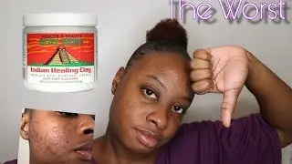 AZTEC HEALING CLAY REVIEW || WORST THING EVER ?? || Remedy for acne ?