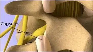 Facet Joint Syndrome