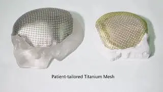cranial orthopedic implant mesh, plate, screw and instrument.