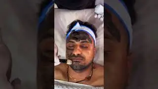Carbon laser peel for open pores acne treatment| Sharad Chaudhary at Skin Plus Clinic GK1