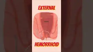 Alamin ang Sakit na Almoranas- By Dr. Ramon Estrada and Doc Willie Ong