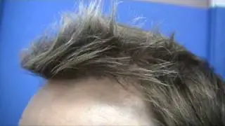 Hair Transplant by Dr Wong - 6091 Grafts - 2 Sessions.