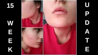 Spironolactone for Acne! 15 WEEK UPDATE! (at Lake Tahoe!) - Episode #13