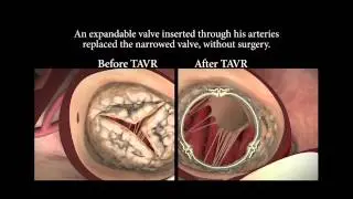 TAVR Heart Valve Replacement - Heart Services