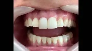 Carillas Cer&aacute;micas  lentes Ceramicos Dr Forero/Colombia cer&aacute;mic Veneers
