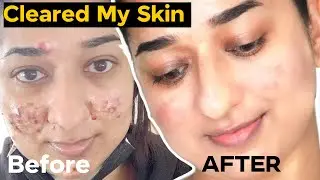 HOW I CLEARED MY ACNE , TEXTURE & HYPERPIGMENTATION ✅ FINALLY SOMETHING WORKED ✅