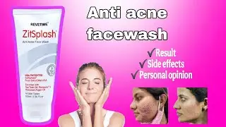 Zitspalash Anti Acne Face wash review  | Best acne facewash