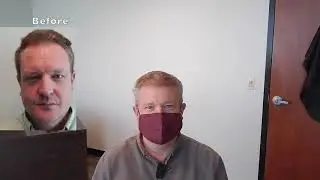 Hair Transplant 5 Years Later. Hair Transplants last. | Great Hair Transplant Surgery for Tampa